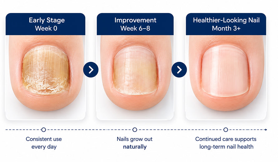 Consistency matters because nails grow slowly